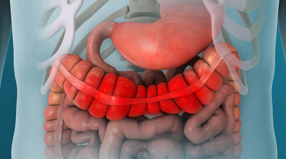 cabbage juice ulcerative colitis