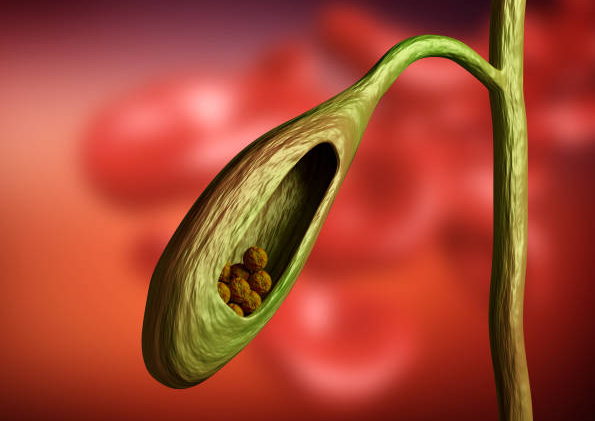 sunflower lecithin for dissolving gallstones
